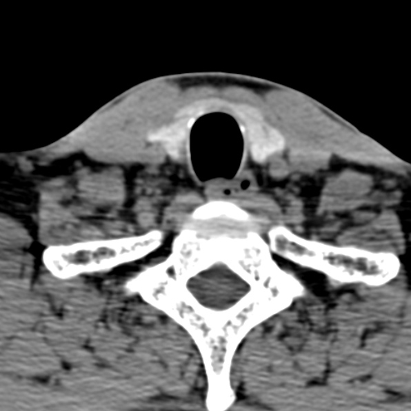 Cervical spondylodiscitis (Radiopaedia 28057-29489 Axial non-contrast 67).jpg