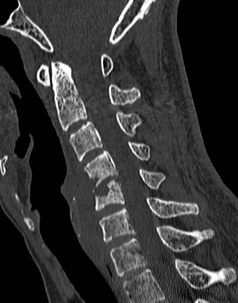 Cervical spondylodiscitis (Radiopaedia 28057-29489 Sagittal bone window 35).jpg