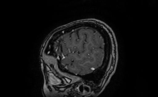 File:Cervical spondylodiscitis and calvarial hemangioma (Radiopaedia 64317-73103 Sagittal T1 C+ 7).jpg