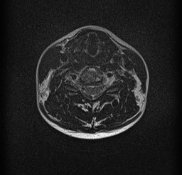 File:Cervical spondylodiscitis and calvarial hemangioma (Radiopaedia 64317-73104 Axial T2 11).jpg