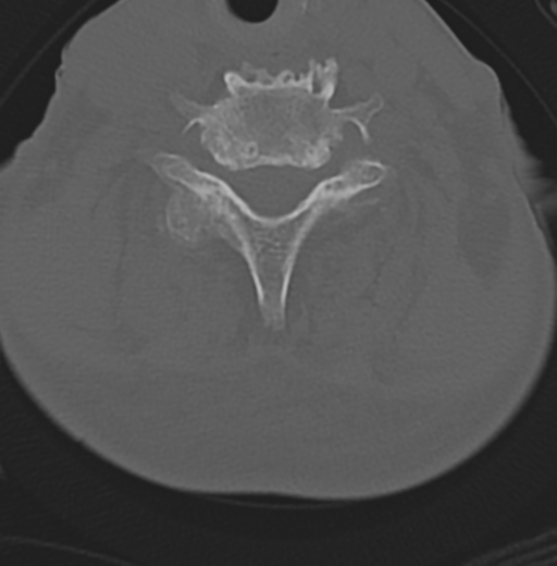 Cervical spondylolysis (Radiopaedia 49616-54811 Axial bone window 39).png
