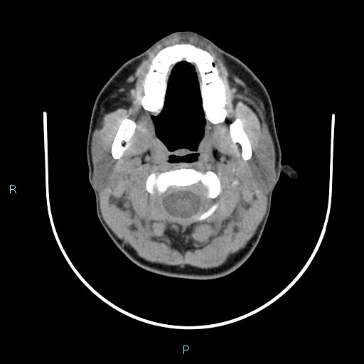 Cervical thymic cyst (Radiopaedia 88632-105335 Axial non-contrast 91).jpg