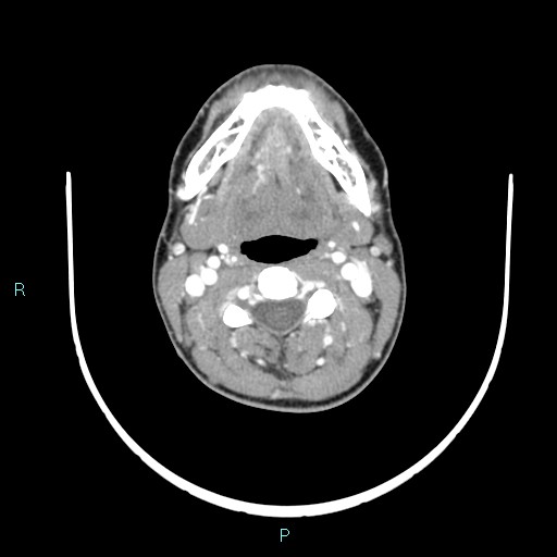 Cervical thymic cyst (Radiopaedia 88632-105335 B 74).jpg