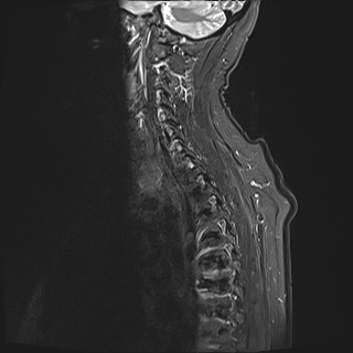 File:Cervical tumor-like myelopathy due to Type V dAVF (Radiopaedia 82461-96604 Sagittal STIR 4).jpg