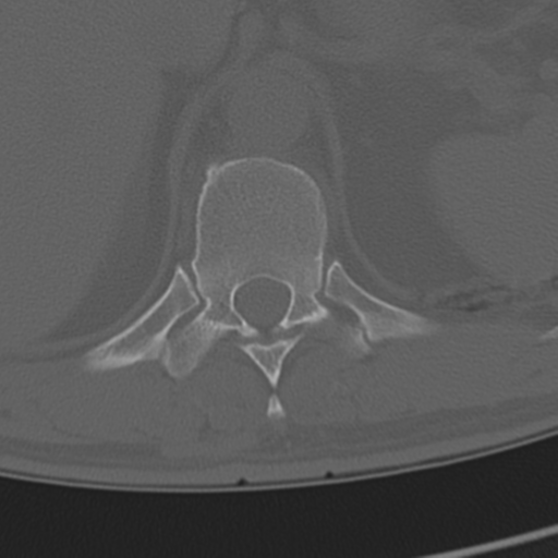 Chance fracture (Radiopaedia 33854-35020 Axial bone window 76).png