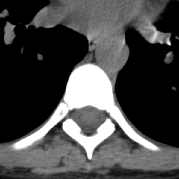 File:Chance fracture (Radiopaedia 36521-38081 Axial non-contrast 13).jpg