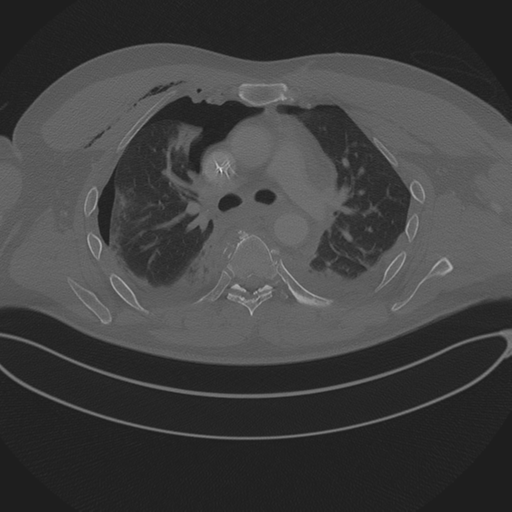 Chest multitrauma - aortic injury (Radiopaedia 34708-36147 Axial bone window 121).png