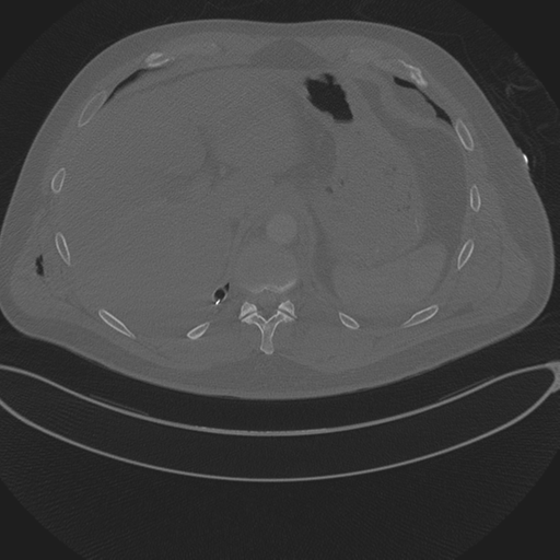 Chest multitrauma - aortic injury (Radiopaedia 34708-36147 Axial bone window 273).png