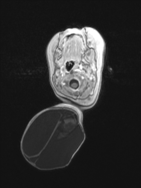 Chiari III malformation with occipital encephalocele (Radiopaedia 79446-92559 Axial T1 C+ mpr 25).jpg