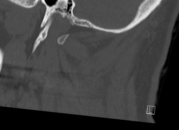 Chiari I malformation with a symptomatic syrinx of the posterolateral medulla oblongata (Radiopaedia 42573-45707 A 11).jpg