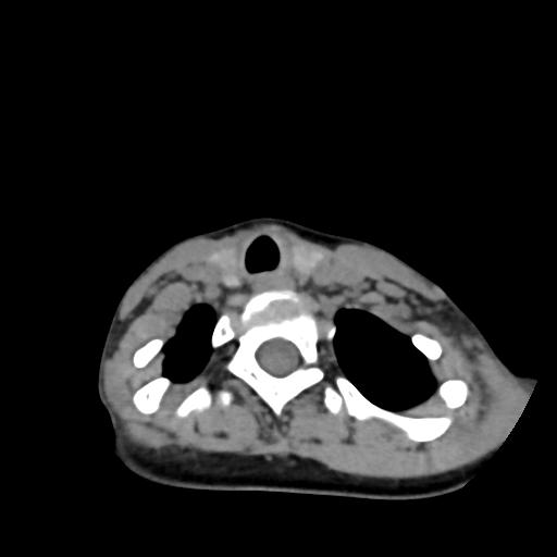 Chiari I with syrinx and skull base anomalies (Radiopaedia 89444-106412 Axial non-contrast 120).jpg