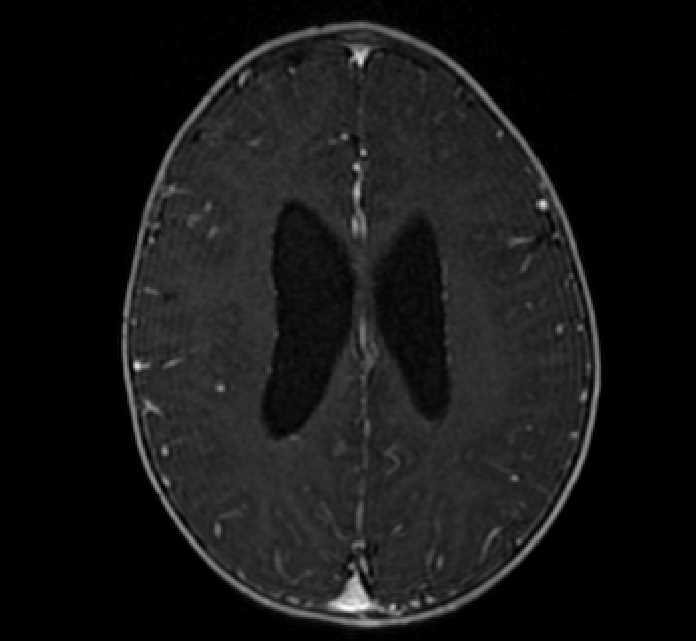 Chiasmatic-hypothalamic glioma (Radiopaedia 90079-107252 Axial T1 C+ 60).jpg