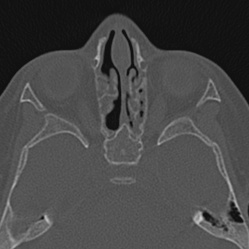 Choanal atresia (Radiopaedia 88525-105975 Axial bone window 64).jpg