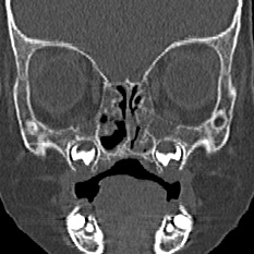 Choanal atresia (Radiopaedia 88525-105975 Coronal bone window 38).jpg
