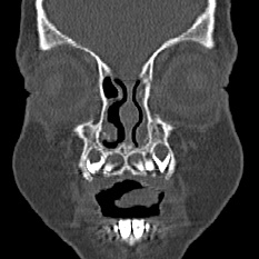 Choanal atresia (Radiopaedia 88525-105975 Coronal bone window 4).jpg