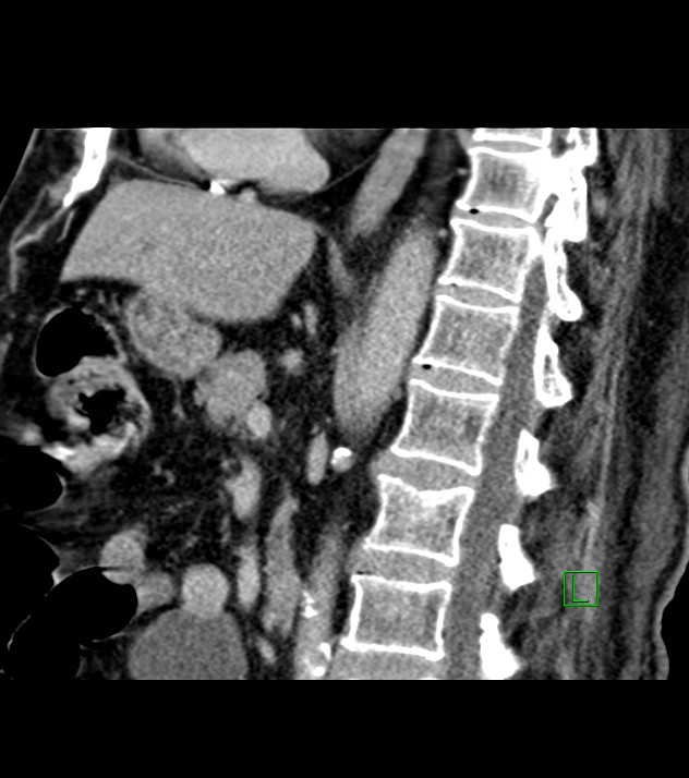 Cholangiocarcinoma with cerebral metastases (Radiopaedia 83519-98629 Sagittal C+ delayed 55).jpg