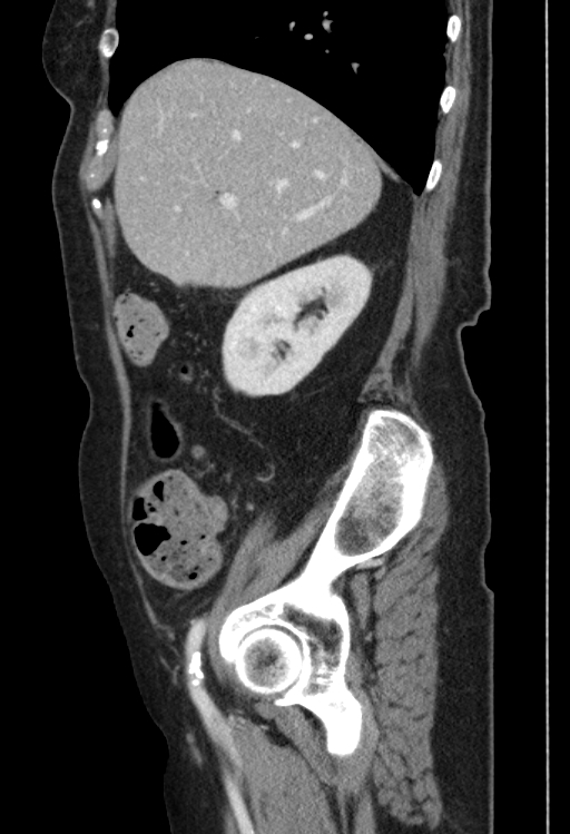 Cholecystoduodenal fistula due to calculous cholecystitis with gallstone migration (Radiopaedia 86875-103077 F 44).jpg