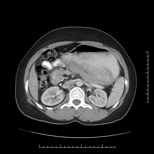 File:Choledochal cyst with chronic calcific pancreatitis (Radiopaedia 18245-18061 A 14).png