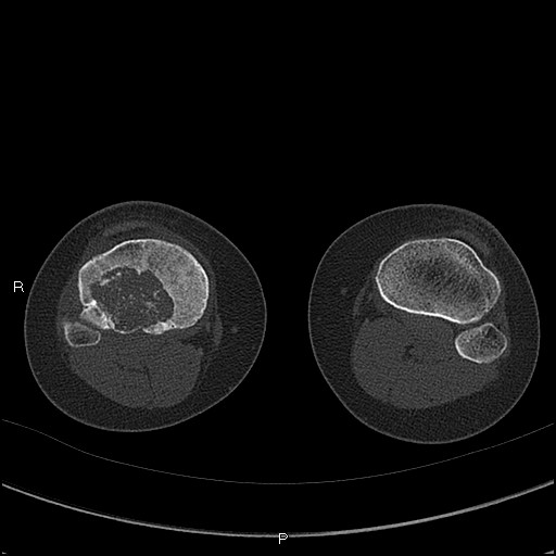 File:Chondroblastoma (Radiopaedia 62721-71030 Axial bone window 64).jpg