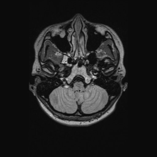 Chondrosarcoma (Radiopaedia 41937-44939 Axial FLAIR 25).png