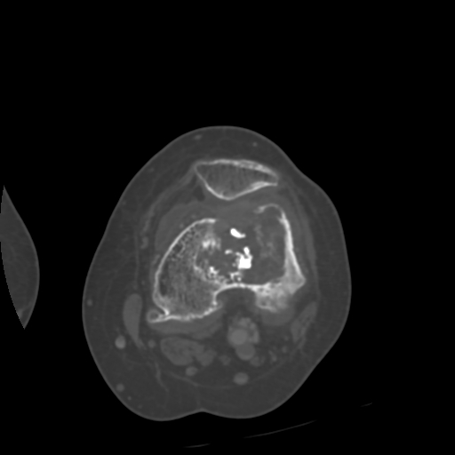 Chondrosarcoma - femur (Radiopaedia 64187-72954 Axial bone window 35).jpg