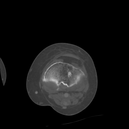 Chondrosarcoma - femur (Radiopaedia 64187-72954 Axial bone window 54).jpg