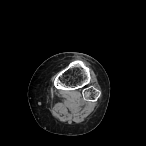 File:Chondrosarcoma - femur (Radiopaedia 64187-72954 Axial non-contrast 74).jpg