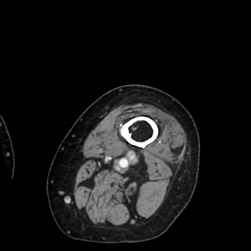 Chondrosarcoma - femur (Radiopaedia 64187-72954 Axial with contrast 4).jpg