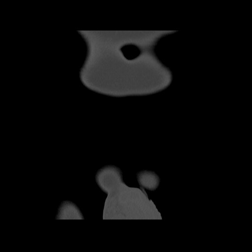 Chondrosarcoma of iliac wing (Radiopaedia 63861-72599 Coronal bone window 12).jpg