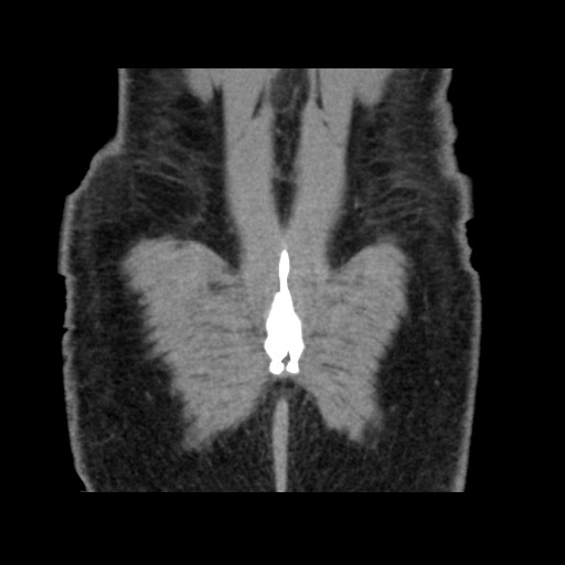 Chondrosarcoma of iliac wing (Radiopaedia 63861-72599 Coronal non-contrast 105).jpg