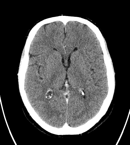 File:Chondrosarcoma of skull base- grade II (Radiopaedia 40948-43653 Axial Contrast 16).png