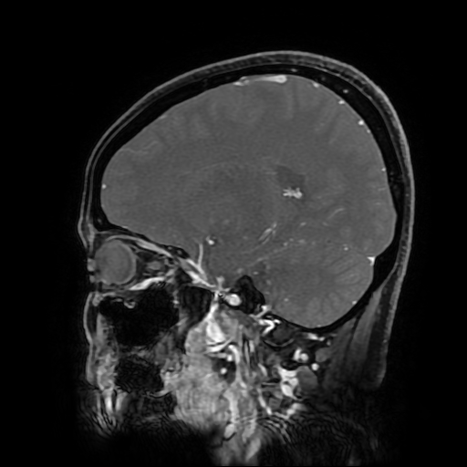 File:Chordoid glioma of third ventricle (Radiopaedia 91612-109340 F 133).jpg