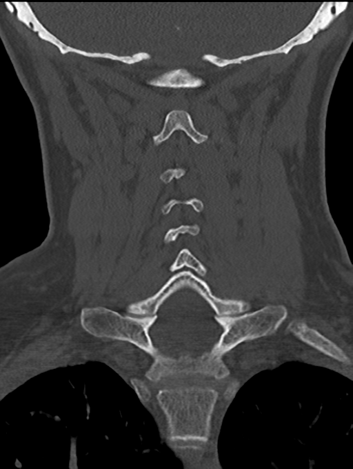 Chordoma (C4 vertebra) (Radiopaedia 47561-52188 Coronal bone window 37).png