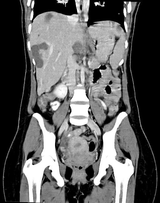 Choriocarcinoma liver metastases (Radiopaedia 74768-85766 B 57).jpg