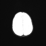 File:Choroid plexus papilloma (Radiopaedia 84612-100019 Axial DWI 20).jpg