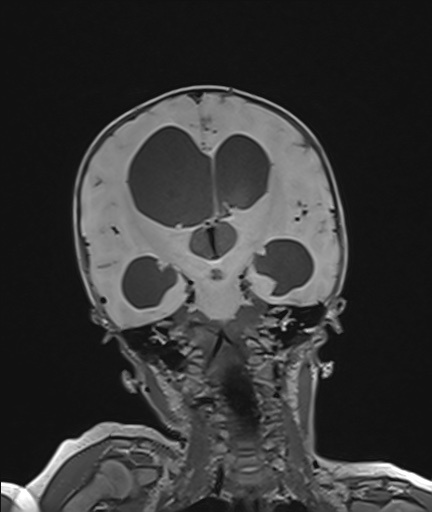 Choroid plexus papilloma (Radiopaedia 84612-100019 Coronal FLAIR 68).jpg