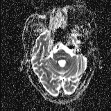 File:Choroid plexus xanthogranuloma - unilateral (Radiopaedia 85632-101393 Axial ADC 18).jpg