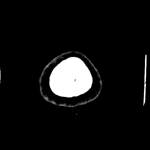 Choroid plexus xanthogranulomas (Radiopaedia 51621-57408 Axial non-contrast 117).jpg