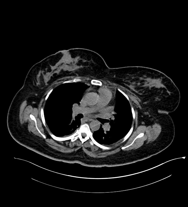 Chromophobe renal cell carcinoma (Radiopaedia 84239-99519 Axial non-contrast 1).jpg