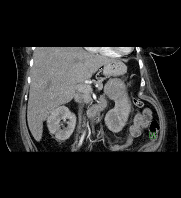Chromophobe renal cell carcinoma (Radiopaedia 84239-99519 C 42).jpg