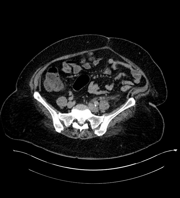 Chromophobe renal cell carcinoma (Radiopaedia 84239-99519 E 113).jpg