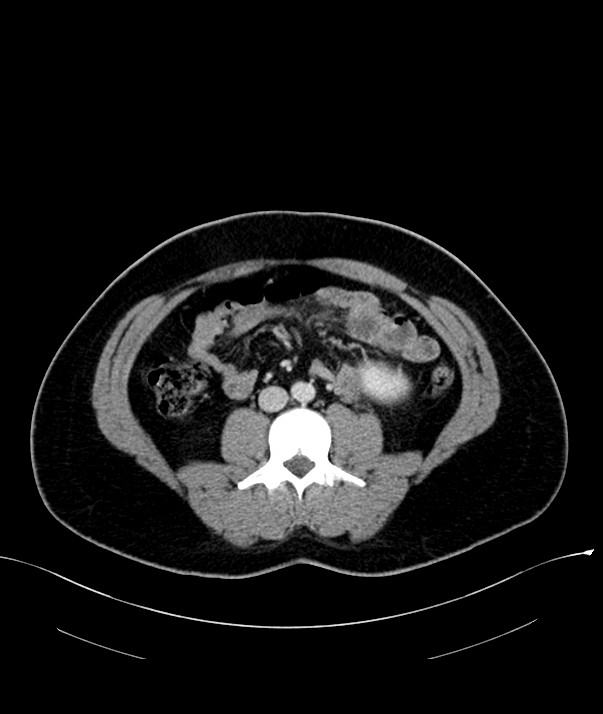 Chromophobe renal cell carcinoma (Radiopaedia 84255-99542 F 44).jpg