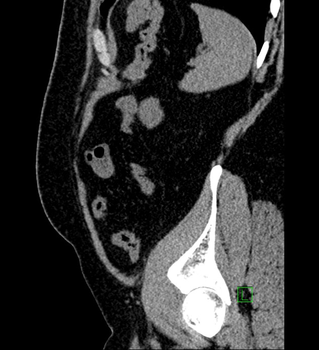 Chromophobe renal cell carcinoma (Radiopaedia 84286-99573 C 27).jpg