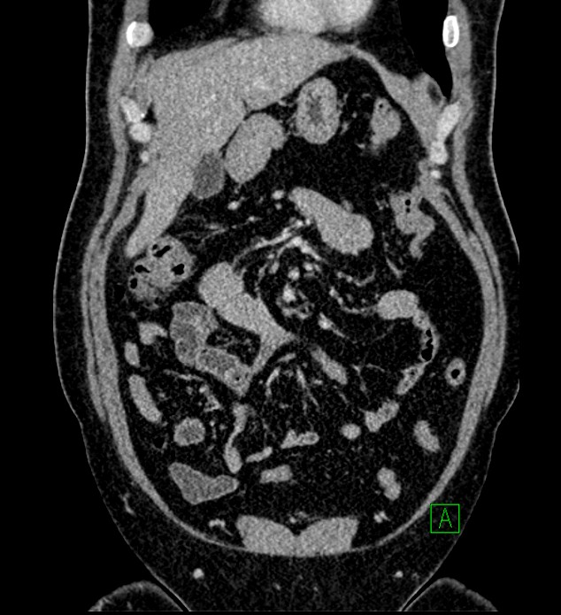 Chromophobe renal cell carcinoma (Radiopaedia 84286-99573 H 51).jpg