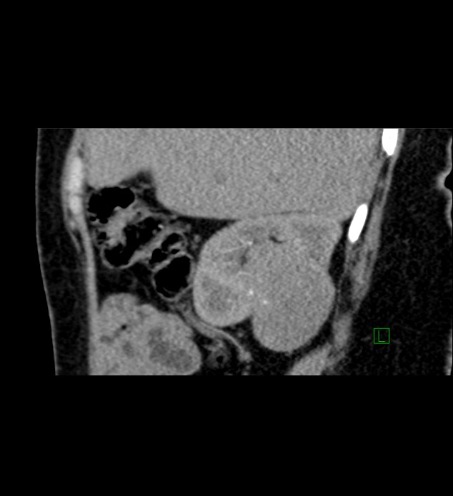 Chromophobe renal cell carcinoma (Radiopaedia 84290-99582 D 74).jpg