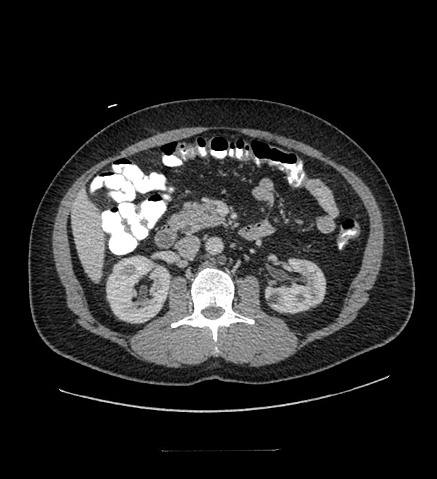Chromophobe renal cell carcinoma (Radiopaedia 84337-99644 C 55).jpg