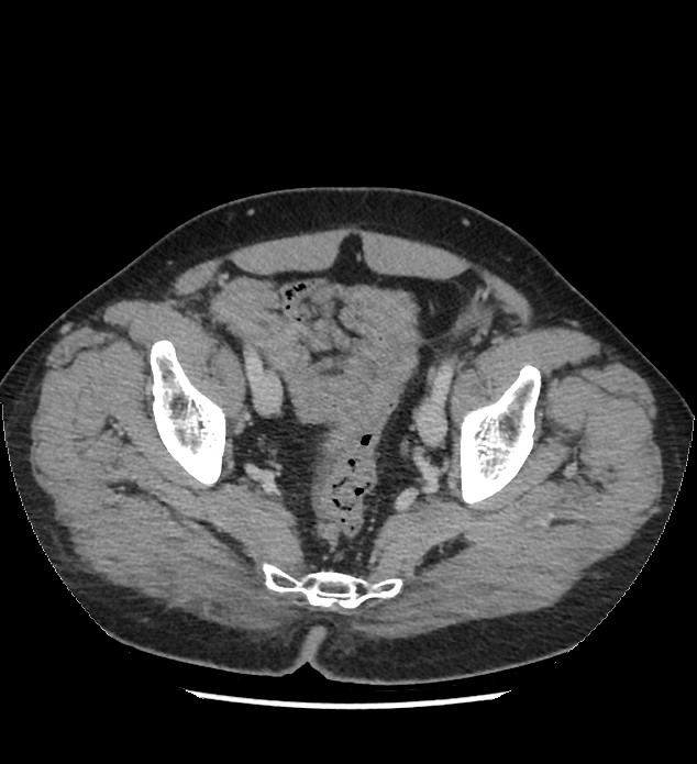 Chromophobe renal cell carcinoma (Radiopaedia 86879-103083 C 132).jpg