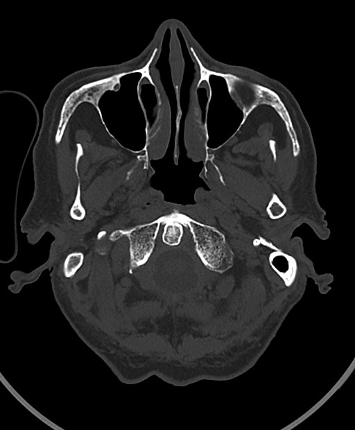 Chronic bilateral subdural hygroma (Radiopaedia 85801-101623 Axial bone window 109).jpg