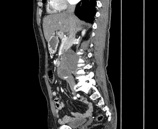Chronic contained rupture of abdominal aortic aneurysm with extensive erosion of the vertebral bodies (Radiopaedia 55450-61901 B 17).jpg