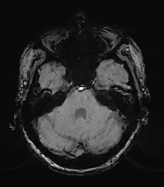 Chronic hypertensive encephalopathy (Radiopaedia 39993-42482 Axial SWI 23).png